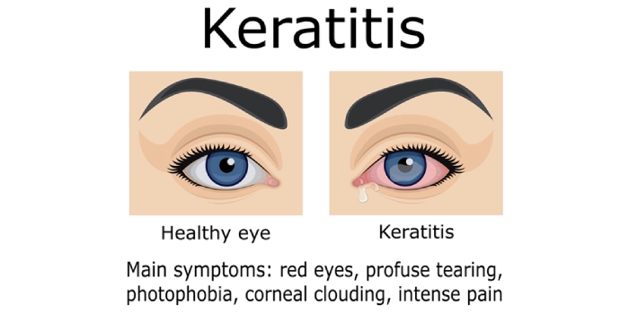 کراتیت باکتریایی چیست؟