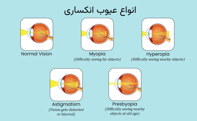 انواع عیوب انکساری