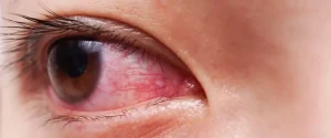 علت قرمزی چشم