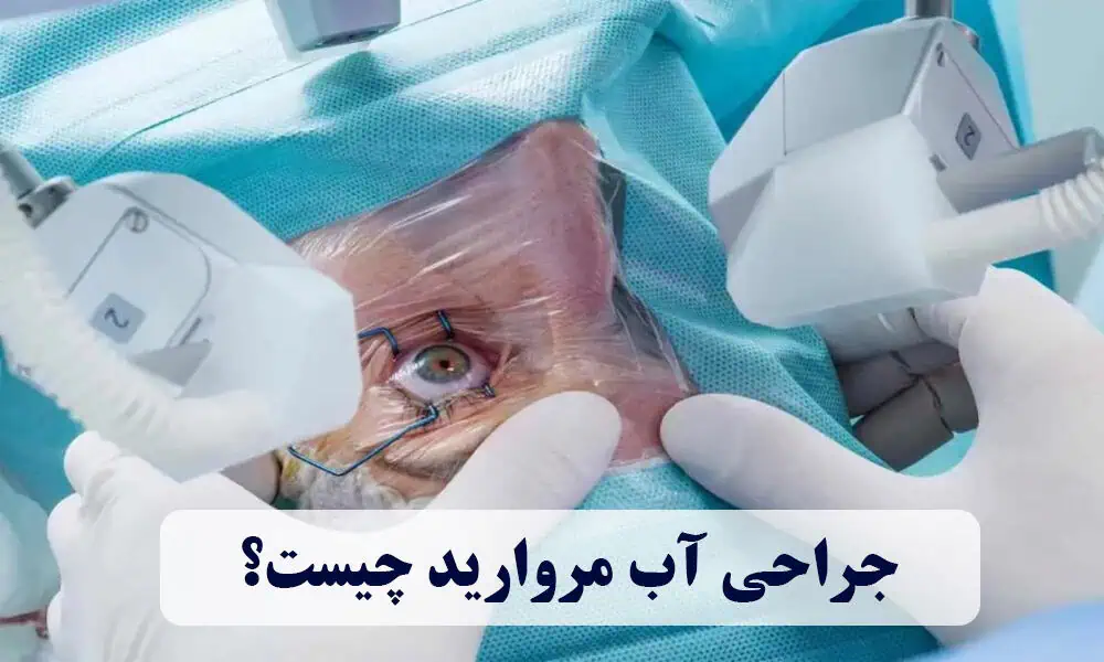 جراحی آب مروارید چیست؟