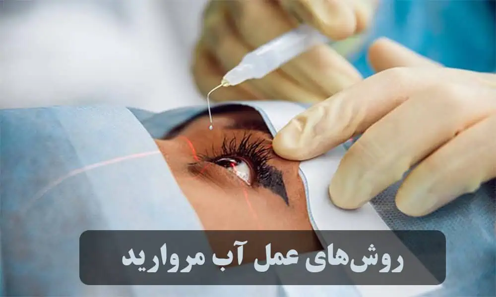 روشهای عمل آب مروارید