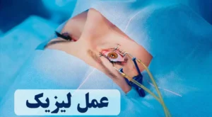عمل لیزیک چشم