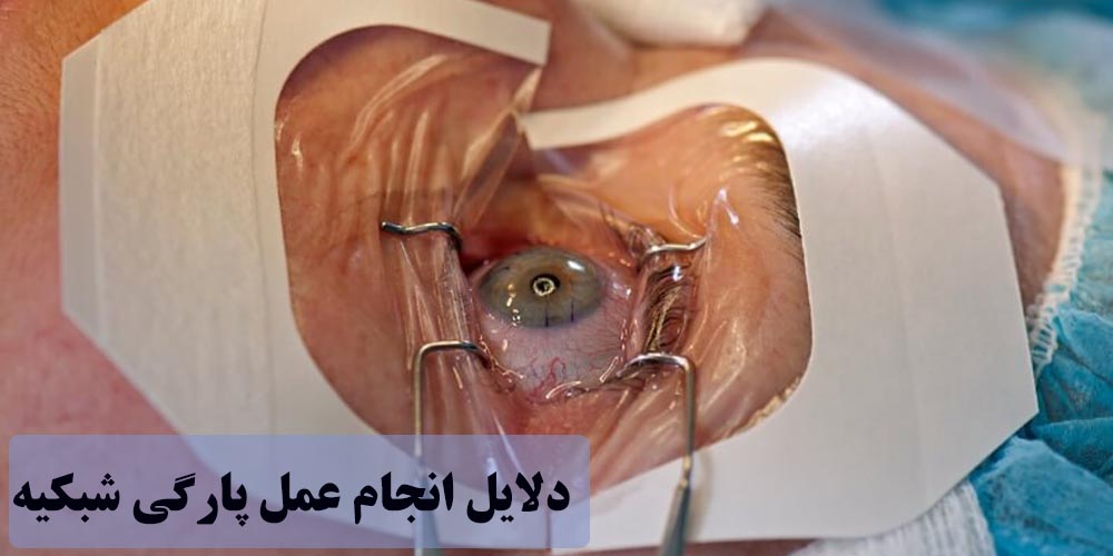  عکس مرتبط به عمل پارگی شبکیه چشم