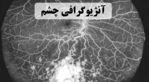 آنژیوگرافی چشم 