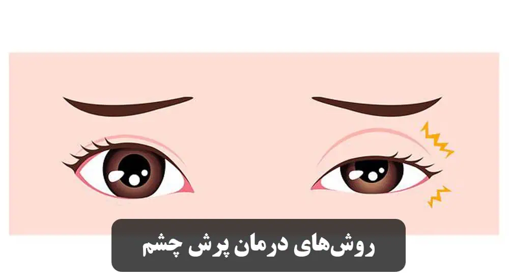 روش‌های درمان پرش چشم 